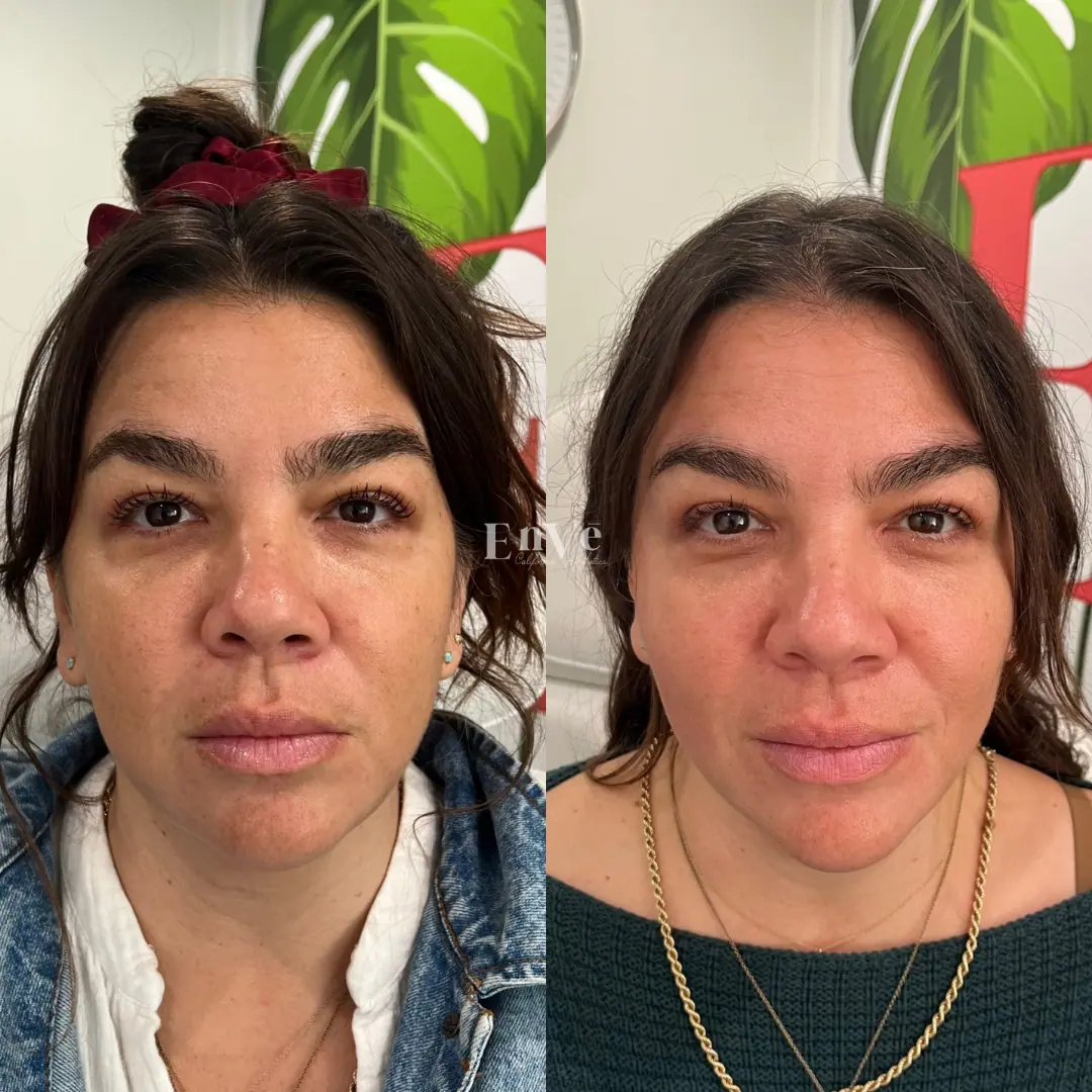 Post-treatment image of a female patient at Enve California Aesthetics in Palm Springs, CA – featuring enhanced facial contours and radiant skin.