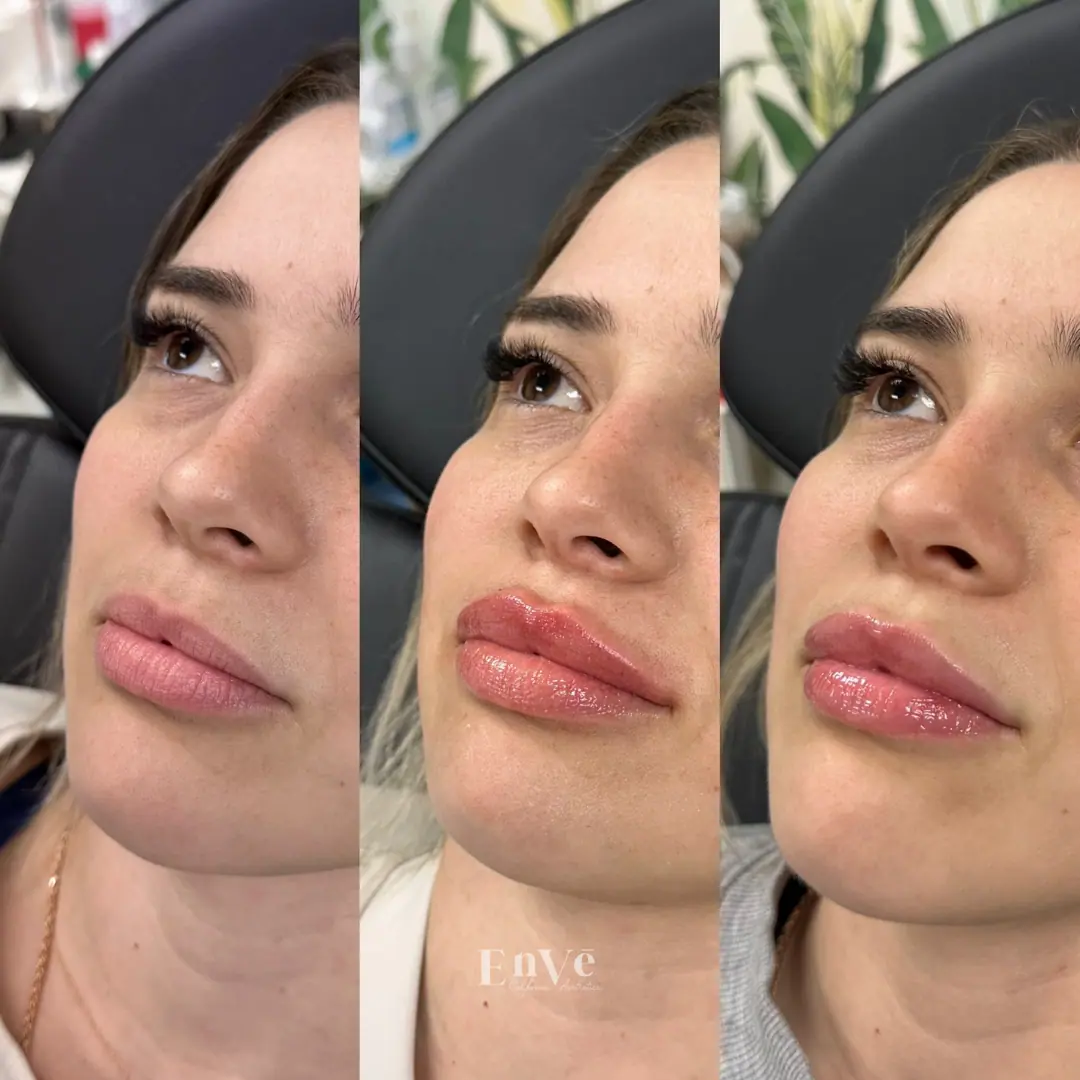 Before and after results of lip filler treatment at Enve California Aesthetics, showcasing enhanced volume and definition for a fuller, natural-looking pout.