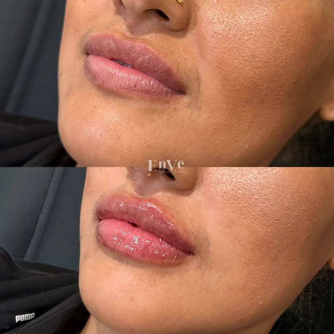 Lip filler enhancement at Enve California Aesthetics showing improved lip shape, volume, and symmetry with natural-looking results.