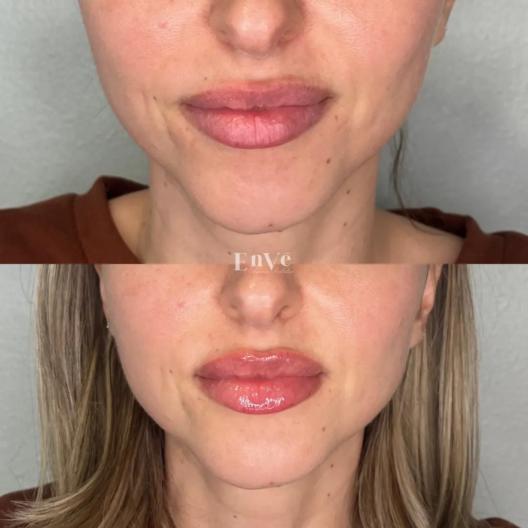 Before And after lip filler treatment at Enve Med Spa showcasing enhanced lip volume and natural contour refinement.