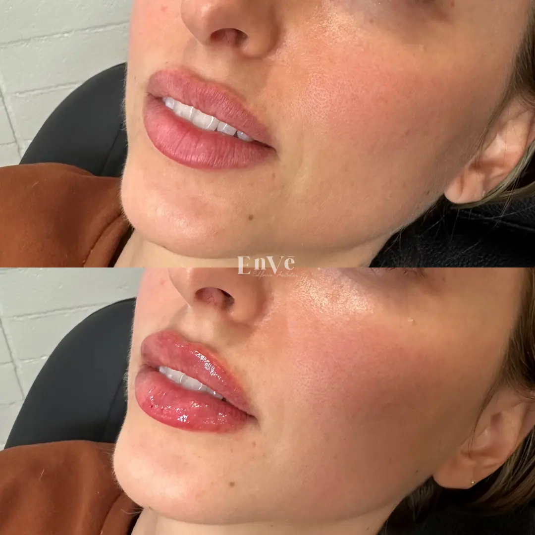 lips after cosmetic filler treatment at Enve California Aesthetics, highlighting plump, symmetrical, and naturally enhanced results.