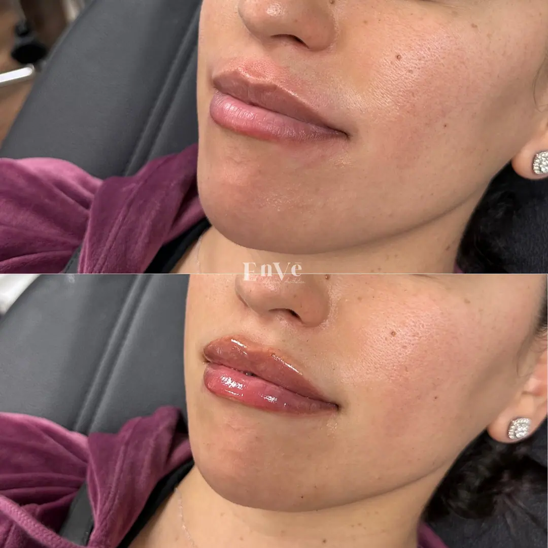 smooth and enhanced lips after lip filler treatment at Enve California Aesthetics