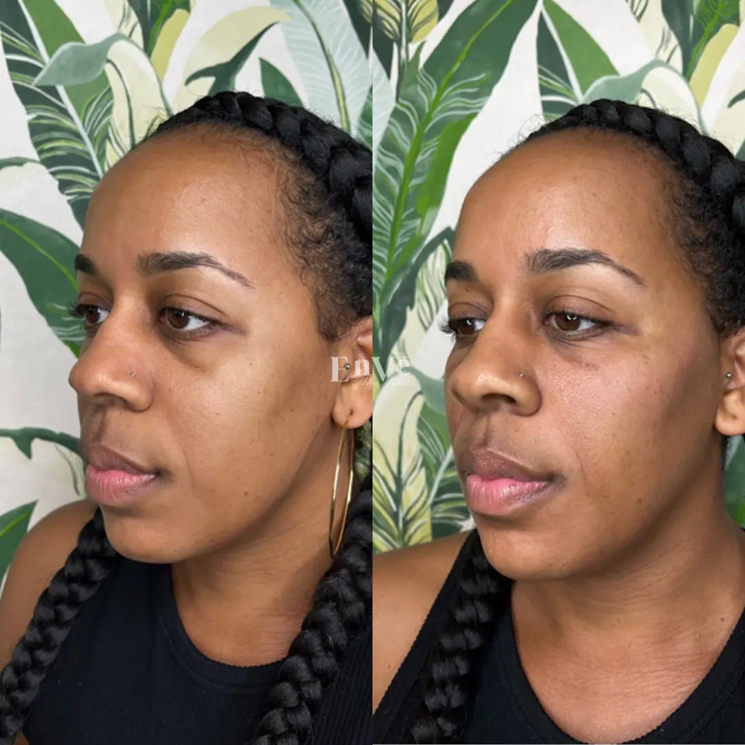 Check Filler Before and After 9 At Enve California Aesthetics