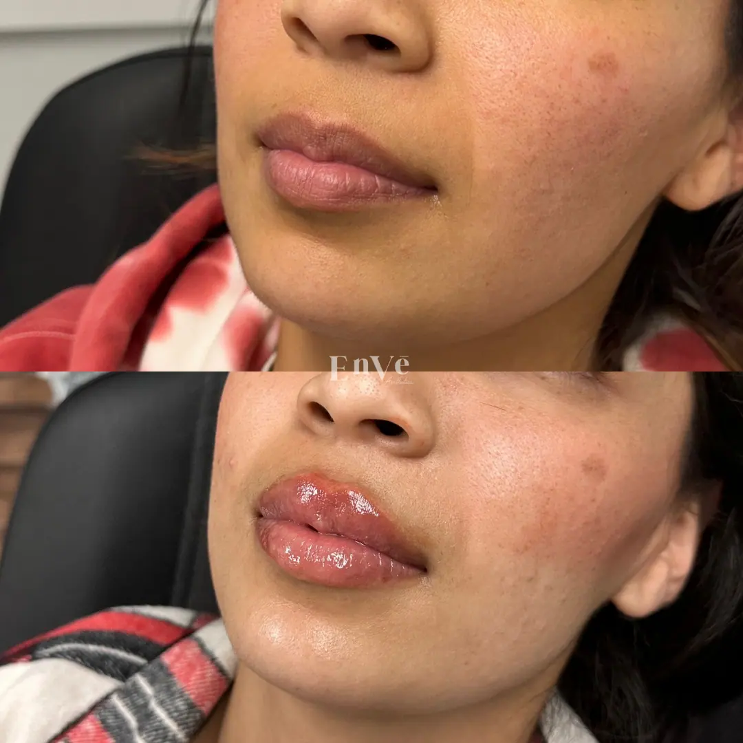 Before and after lip filler treatment enhanced lip volume and definition at Enve California Aesthetics