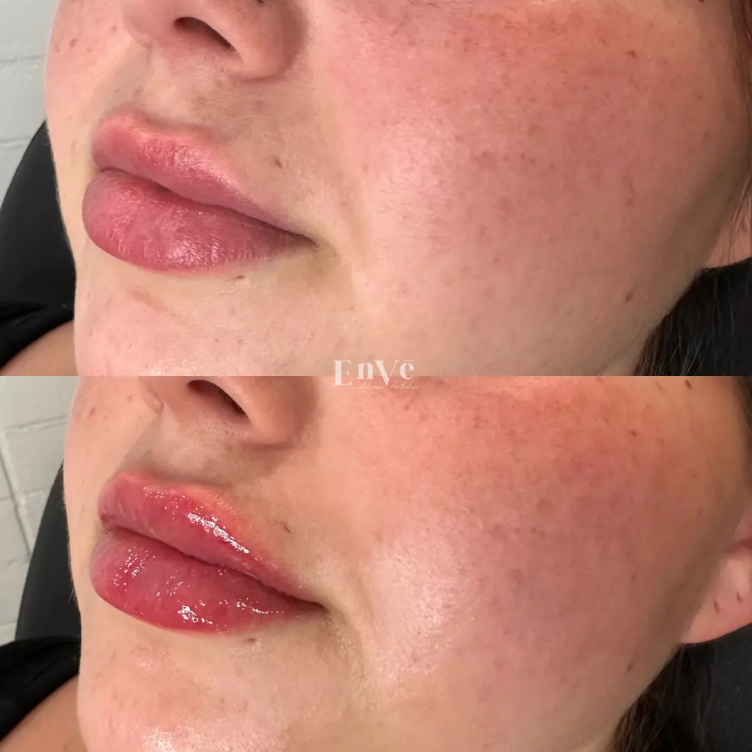 Lip enhancement results after filler treatment at Enve California Aesthetics, showing fuller, natural-looking lips.