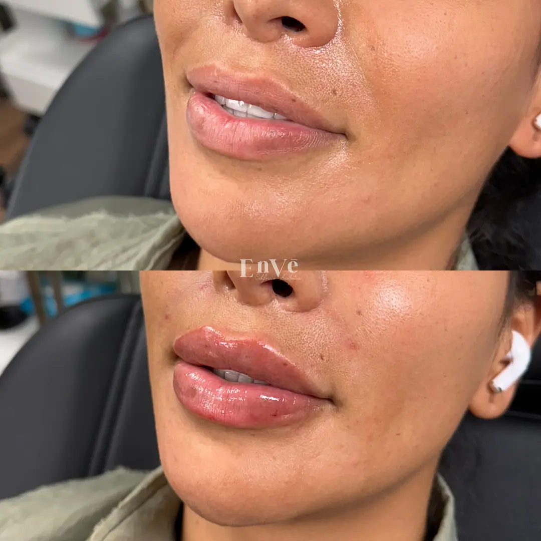 Enhanced lips after filler treatment at Enve California Aesthetics in Palm Springs, CA – featuring fuller volume and defined lip contours.