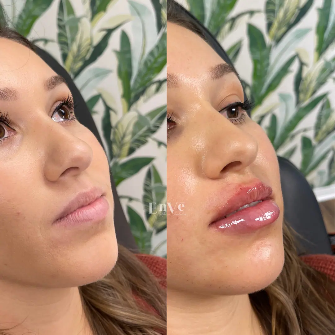 Lip Filler Before and After 32 At Enve California Aesthetics