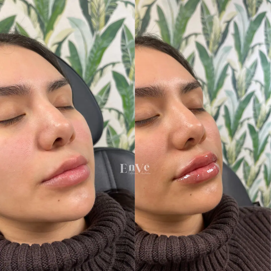 Lip Filler Before and After 33 At Enve California Aesthetics