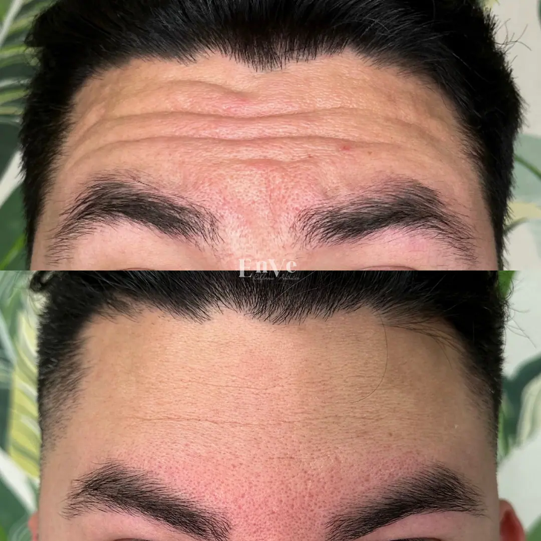 Botox treatment before and after comparison showing reduced wrinkles and smoother skin