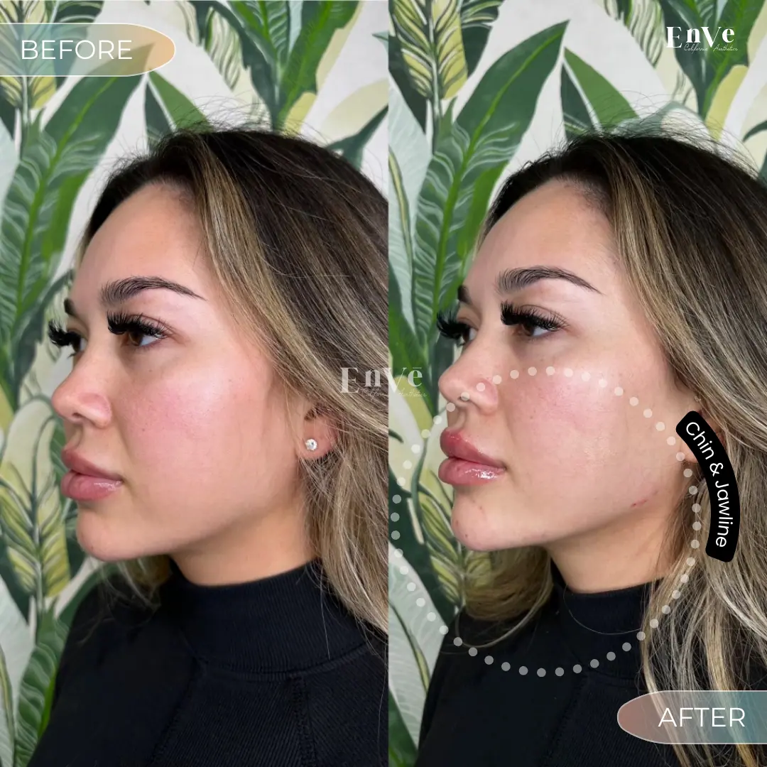 Chin Filler Before and After10 in Palm Springs & Orange County CA