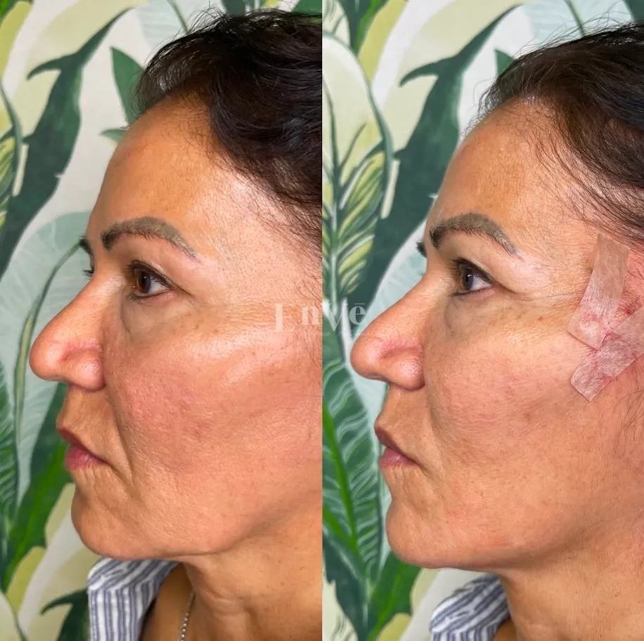 PDO Thread Lift Before and After at Enve California Aesthetics