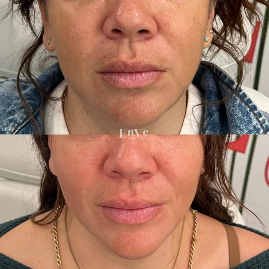 Lip Filler Treatment Before and After1 at Enve California Aesthetics