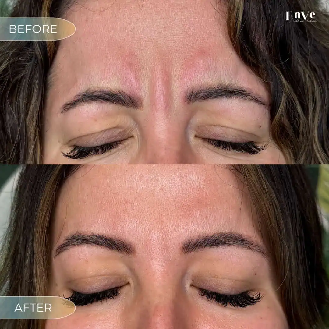 Botox Before and After1 at Enve California Aesthetics