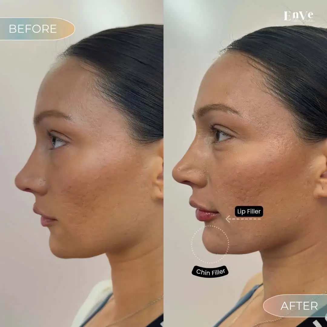 Chin Filler Before and After at Enve California Aesthetics