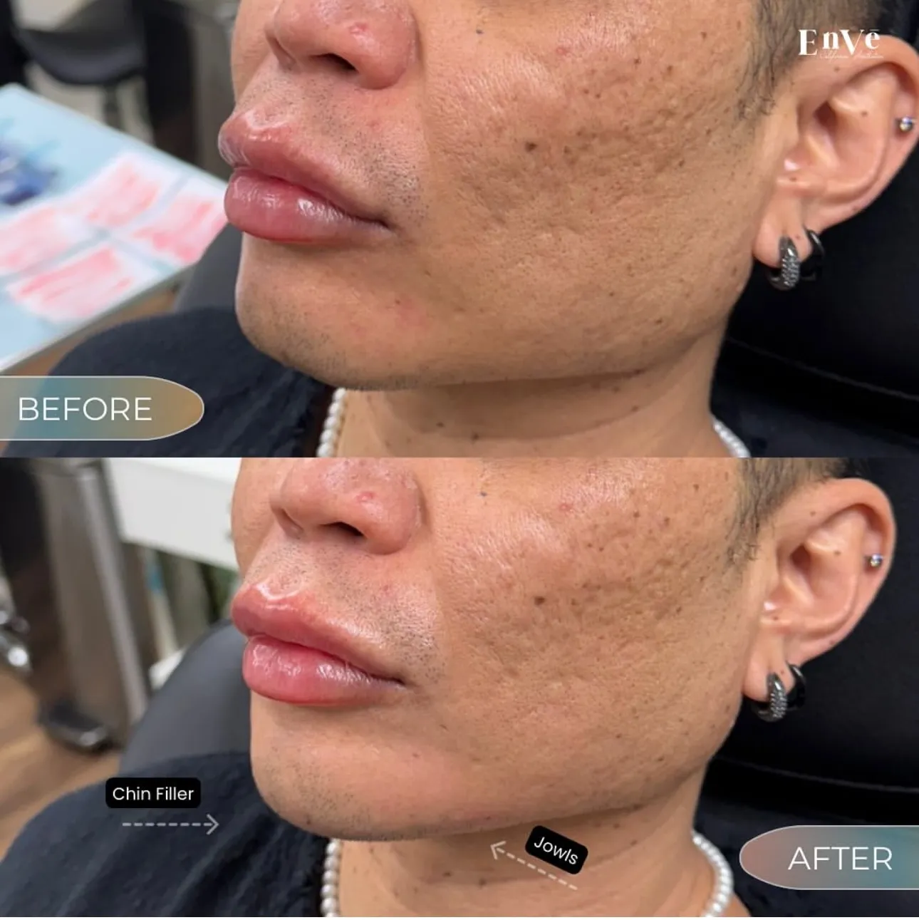 Chin filler Before and After at Enve California Aesthetics
